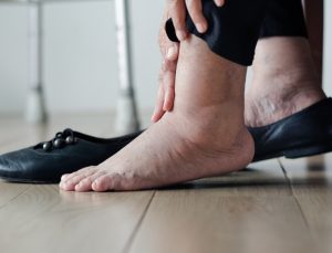 Geçmeyen ayak şişliği kalp yetersizliğinin habercisi olabilir
