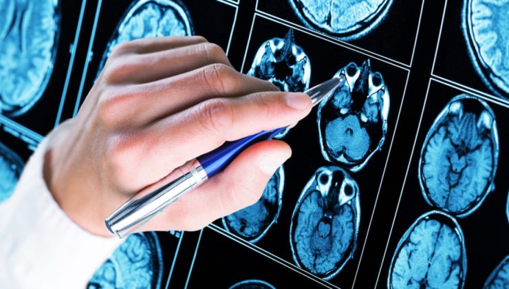 Alzheimer tedavisinde yeni dönem! Antikor tedavisi evde uygulanabilecek