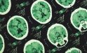 Alzheimer’ın izleri unutkanlıktan yıllar önce başlayabiliyor