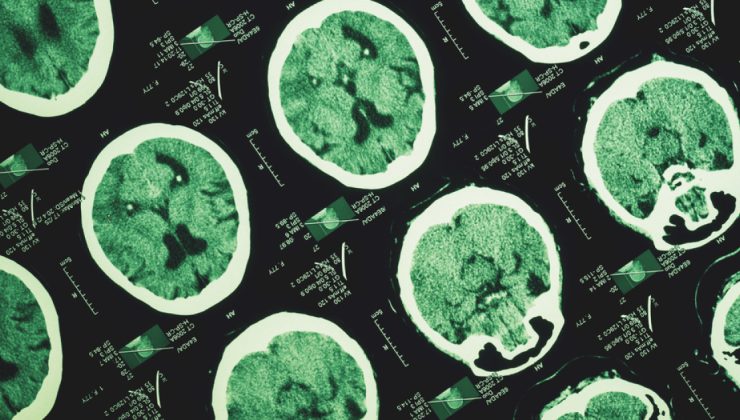 Alzheimer’ın izleri unutkanlıktan yıllar önce başlayabiliyor