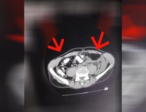 Hepsi mide ve bağırsaklarından çıktı! Tutuklanarak cezaevine gönderildi