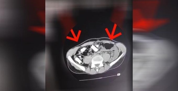 Hepsi mide ve bağırsaklarından çıktı! Tutuklanarak cezaevine gönderildi