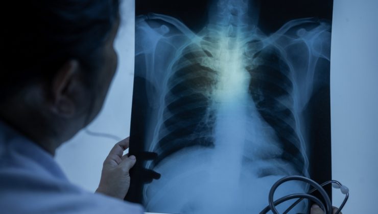 Tütün kullanımı akciğer kanseri riskini 20 kat artırıyor