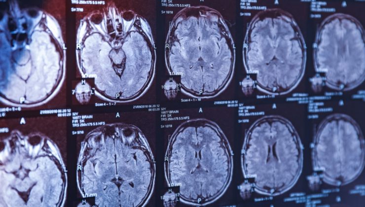 İnme tedavisinde zamana karşı yarışta 101 birim görev yapıyor